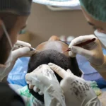 Scalp Micropigmentation Versus Hair Transplants