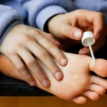 The Fastest Ways to Remove Warts Permanently