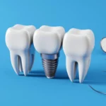 Everything You Need to Know About Dental Implant Surgery Near You