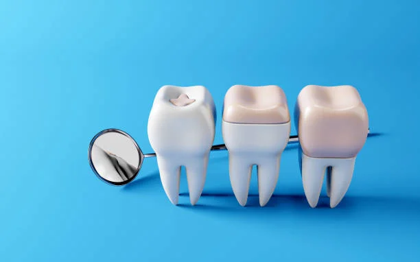 Dental Restorations