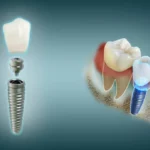 Metal, Ceramic, or Clear Braces: A Lifestyle Guide to Straighter Smiles