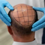 How to Choose the Best Hair Loss Treatment for Men