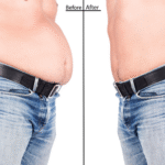 Is a Fat Melting Injection Right for You? Expert Insights from Dubai Clinic