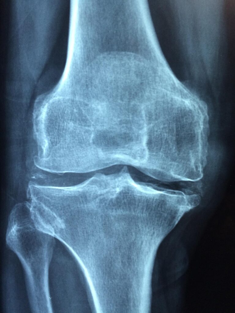 Maintaining Joint Health
