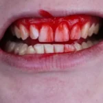 Why Bleeding Gums Are a Warning Sign You Shouldn’t Ignore
