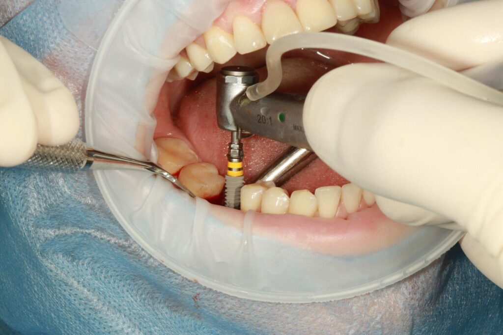 The Complete Guide to Dental Implant Treatment and Care