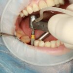 The Complete Guide to Dental Implant Treatment and Care
