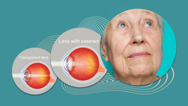 Cataract Symptoms