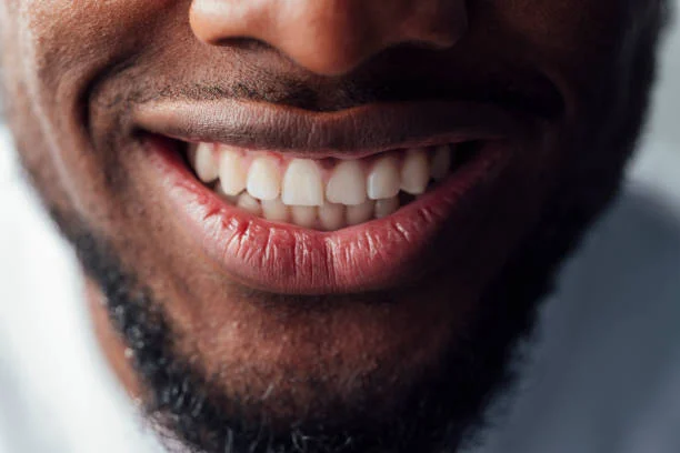 Composite Bonding Newcastle, Say Goodbye To Chips And Discolouration