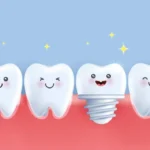 Revolutionizing Smiles: Comprehensive Guide to All on 4 Dental Implants