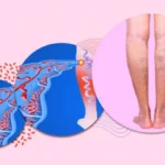 Effective Varicose Vein Treatment: A Comprehensive Guide by The Vein Institute