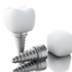 Tailored Tooth Replacement Plans for Better Fit