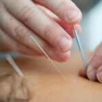 Expert Acupuncture Care: Holistic Healing for Mind and Body