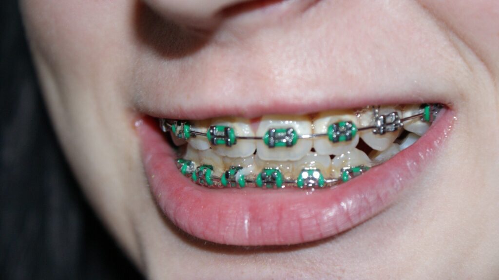 Professional Ceramic Braces Services for a Straighter Smile