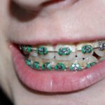 Professional Ceramic Braces Services for a Straighter Smile